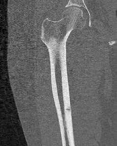 Stress Fracture Medial